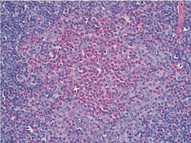 Histopathology of the lymph node showing an eosinophilic micro-abscess. Haematoxylin and Eosin stain. Magnification ×20.