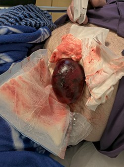Picture of the prolapsed stoma.