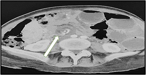 Swirl sign with dilated bowel loops CT scan 2021.
