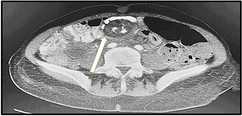 Swirl sign found in CT scan from the first admission in 2017.