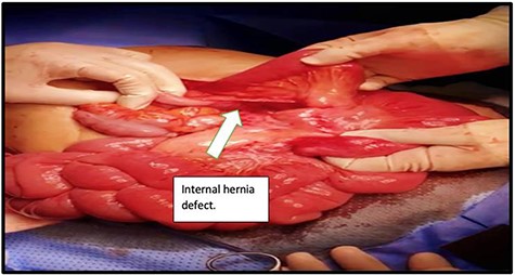 Peterson’s defect found behind the Roux limb and the mesentery of the transverse colon.