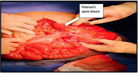The defect was continuously closed with non-absorbable sutures.