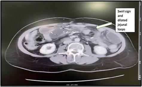Swirl sign and dilated proximal jejunal loops.