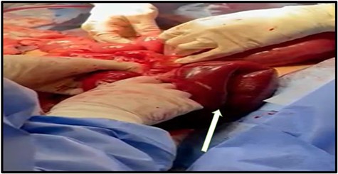 Segment of the jejunum gangrenous.