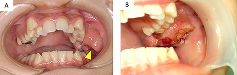 (A) intraoral findings of a suspected neoplastic lesion extending from the maxillary tuberosity to the left maxillary first molar at the time of initial examination (arrowhead); (B) intraoral findings at the time of biopsy; the sectioned surface was milky-white with enhancement characteristics