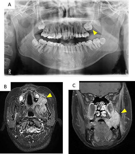 Imaging findings; (A) a panoramic radiograph showing impaction of the maxillary second molar and resorption of alveolar bone between the left maxillary molar area and the maxillary tuberosity (arrowhead); (B and C) contrast-enhanced T-1 weighted MRI showing a high signal in the mass extending from the left masticator space to the buccal space and the maxillary and mandibular alveolar regions (arrowhead)