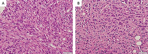 Histopathological findings; (A) proliferating oval to spindle-shaped cells, with hyperchromatic nuclei and high nuclear-cytoplasmic ratio, arranged in a fascicular pattern, and frequent mitotic figures (×200); (B) tumor cells arranged in small nests and pseudo-capillary pattern in the sclerotic collagenous stroma, in part (×200)