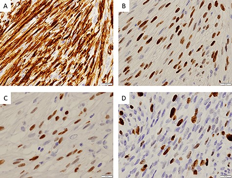 Immunohistochemical findings; (A) immunohistochemical staining showing positivity for desmin (×400); (B) myoD1 (×400); (C) myogenin (×400) and (D) ~30% of tumor cells were positive for Ki67 (×400)