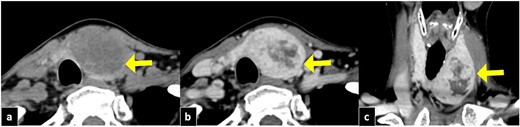 Cervical CT imaging. The tumor is well defined in the left lobe of the thyroid gland, with a size of 50 mm. (a) CT section in the axial section, showing a tumor with low density (arrow). (b) Axial section with gadolinium contrast (arrow). (c) Coronal section with gadolinium contrast (arrow).