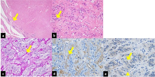 Pathological features of HTA of the thyroid. (a) The tumor is well circumscribed with a thin fibrous capsule (arrow). Hematoxylin and eosin staining, ×20. (b) Spindle-shaped and intranuclear inclusions (arrow) can be identified. Hematoxylin and eosin staining, ×400. (c) PAS-positive hyalinizing material can be seen between the trabecular structures (arrow). PAS staining, ×400. (d) Hyalinization is positive (arrow). Collagen type IV staining, ×400. (e) Ki-67 staining was positive for cytoplasm and negative for the cell membrane (arrow). The nucleus was nearly negative (triangle).