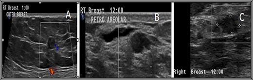 Ultrasound (US) scan of the right breast revealed innumerable hypoechoic breast lesions. (A) Some of them appear round with well-defined regular borders. (B) Others show microlobulated borders with additional dilated duct beside. (C) Others show indistinct borders.
