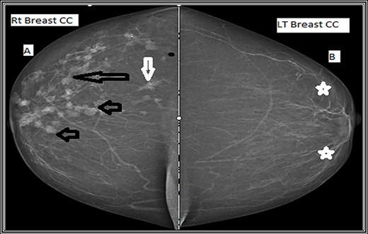 Craniocaudal mammographic view. (A) The right breast shows multiple variable size dense mass lesions, showing regularly lobulated borders (short black arrows), indistinct borders (long black arrow) and speculated outer borders (short white arrow). (B) The left breast shows scattered areas of fibroglandular densities (white stars).