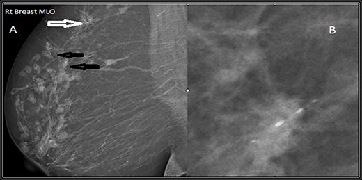 Mediolateral oblique (MLO) mammographic view of the right breast. (A) Shows multiple foci of microcalcifications arranged in linear distribution (black arrows) and others in clusters (white arrows). (B) Spot magnification view of the most suspicious lesion shows linear fine microcalcifications.