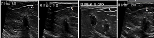 US follow-up after the first biopsy revealed several findings: (A) the most outer lesion can be seen at 9:00 and became vertically oriented inside the breast parenchyma with irregular serrated margins; it infiltrated the adjacent breast parenchyma and the deep posterior acoustic shadow. (B) A tiny microcalcification can be seen at its upper pole. (C and D) An enlargement of the previously seen mass lesions after a second biopsy in which all of them have microlobulated borders and are longitudinally oriented inside the breast tissue can be observed.