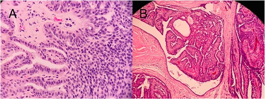 Histopathology slides (A) CNB showing papilloma lined by a double-layer epithelium with foci of ADH without invasion. (B) Postmastectomy, showing a solid DCIS.