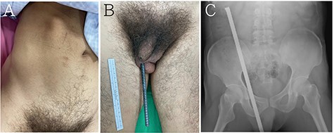 (A, B) a steel bar penetrated his left scrotum and extended to his abdomen. (C) Abdominal radiography showed the penetration extended from the left scrotum to the right abdomen but indicated no injury to the pelvic bone or spine.