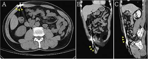 Abdominal CT demonstrated that the penetration extended from the left scrotum to the right anterior abdomen wall (the steel bar: yellow arrow head) in (A) axial view, (B) coronal view and (C) sagittal view.