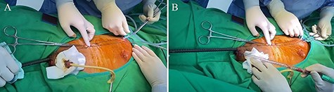 (A, B) curved Kelly forceps along with JP drain guided to remove the steel bar simultaneously and prevented from wrong placing tract.