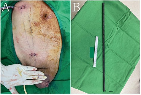 (A) Two skip incisions were created to remove (B) the steel bar.