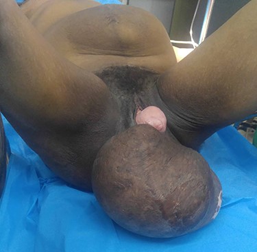 Preoperative view of the patient in supine position showing an abdominal mass and a large perineal lump with hysterocele grade 4.
