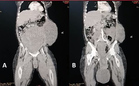 Coronal view of abdominal enhanced CT scan showing: (A) large, well-limited and slightly enhanced abdominopelvic mass. (B) protusion of the abdominopelvic mass trough perineum.