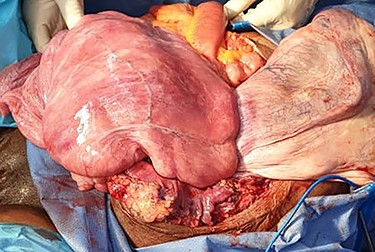 Operative view showing a firm multilobed and fibromatous mass.