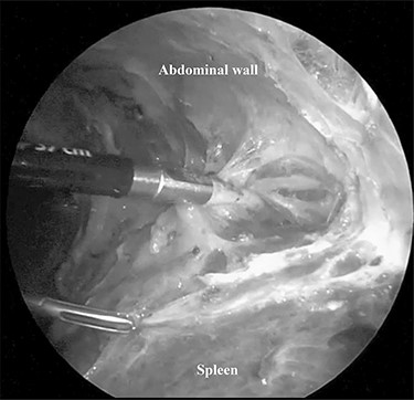 Dense adhesions around the spleen were divided under 3-mm needlescope.