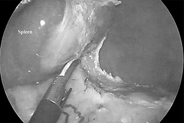 The spleen was freed from the splenorenal ligament using laparoscopic coagulating shears.
