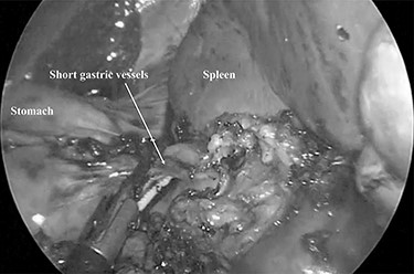 The short gastric vessels were divided at the splenic hilum.
