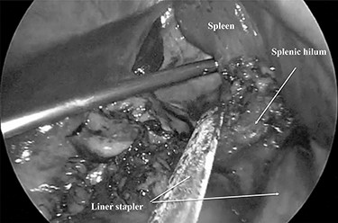 The splenic hilum was divided using an Endo-GIA linear stapler.