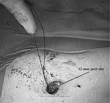 A view of port site after removing the spleen.