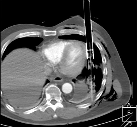 CT axial view of penetrating solar powered garden light demonstrating proximity of metal shaft to heart and the plastic tip resting against the posterior thorax.