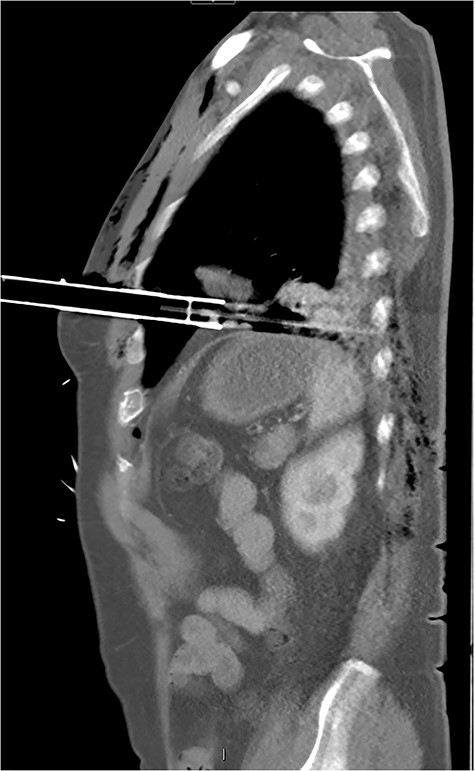 CT sagittal image showing depth of intrathoracic penetration by solar powered garden light.