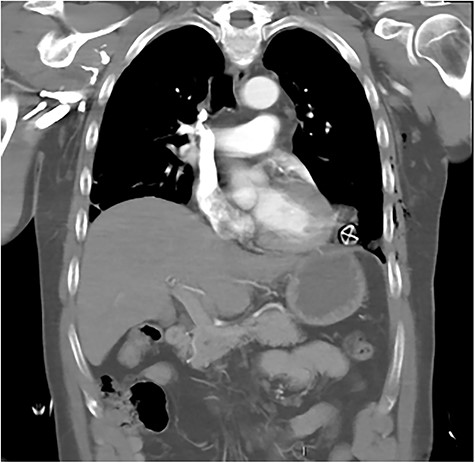 CT coronal image showing solar powered garden light proximity to diaphragm and cardiac border.