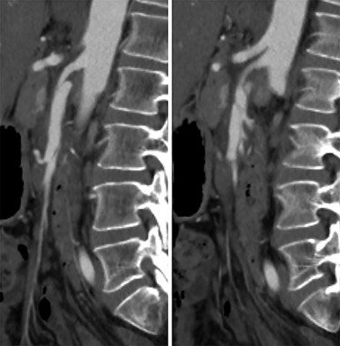 CT angiogram of the SMA dissection demonstrating the Left: false lumen supplying the middle colic artery with Right: the narrowed true lumen supplying the other SMA branches.