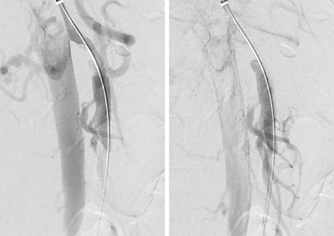 Pre-stenting angiogram of the SMA demonstrating early filling of the false lumen including the middle colic artery.