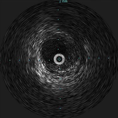 Intravascular ultrasound probe within the true lumen, with false lumen visualized to the bottom right of the probe.