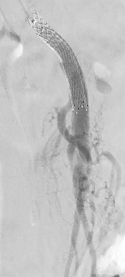 Post-stenting angiogram of the SMA demonstrating preservation of the middle colic artery as well as the distal branches of the SMA.