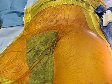 Swelling in the left thigh.