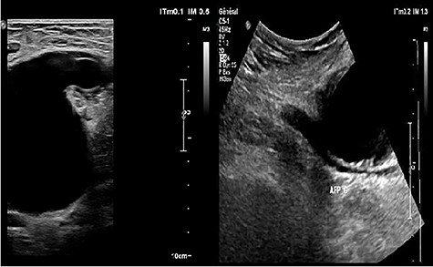 US showed a PSA of the proximal SFA.