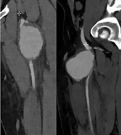 Computer tomography angiogram showed a PSA of the proximal SFA.