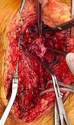 Intraoperative images showing the a PSA SFA aneurysm.