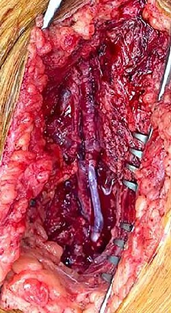 Interposition of the reversed great saphenous vein.