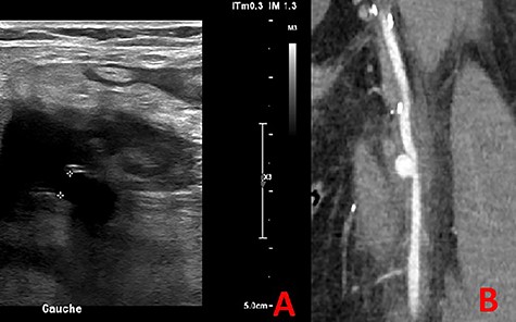 US (A) and CTA (B) showed a PSA of the SFA.