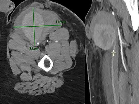 CTA showed a PSA of the SFA with active bleeding.