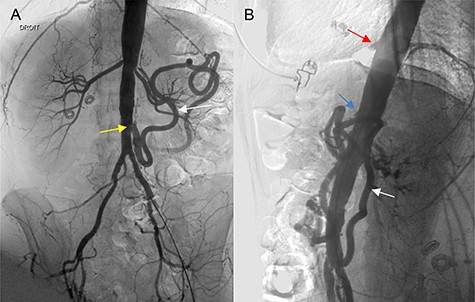 (A, B) Angiography of the abdominal aorta (preoperative), demonstrating the occlusion of the CT (red arrow) and SMA (blue arrow) with severe stenosis of the IMA (yellow arrow). Retrograde flow of the arc of the Riolan artery is shown (white arrow).