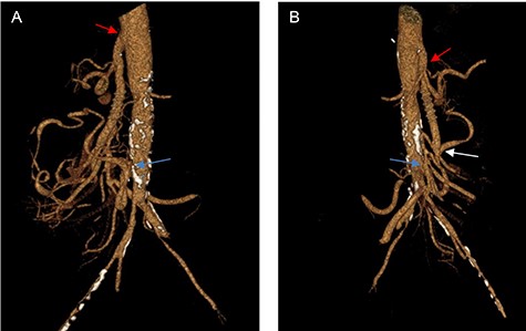 (A, B) Three-dimensional CT reconstruction at 1-year follow-up, showing the anastomosis of the CT (red arrow), the anastomosis of the SMA (white arrow) and the reimplantation of the IMA (yellow arrow) with excellent graft patency.