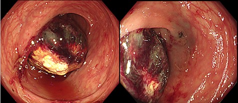 Colonoscopy findings: a submucosal tumor with ulceration and necrosis at the surface was detected in the colon 40 cm from anal verge. There were no other abnormal lesions in her colon.