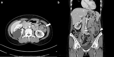 Enhanced CT imaging of abdomen: (a) axial view. Three-layer like appearance indicating the intussusception was found in left side of colon (arrow). (b) Coronal view. The lead mass was detected as a 3.5-cm low-density tumor (arrowhead).