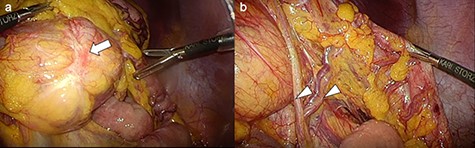 Operative findings: (a) A tumor was detected in the left transverse colon (arrow). The tumor had good mobility with no evidence of invasion to the surrounding tissue. (b) The main feeders of the tumor were branches of the left colic artery (arrowhead).